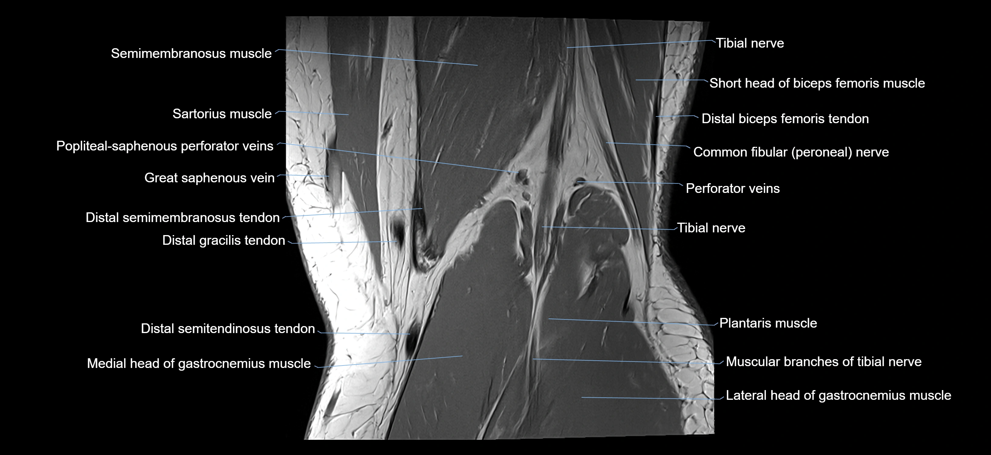MRI knee coronal cross sectional anatomy labelled 3T radiology  image-04001-00036.webp
